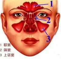 鼻窦炎鼻窦炎(鼻窦炎与鼻炎的区别)