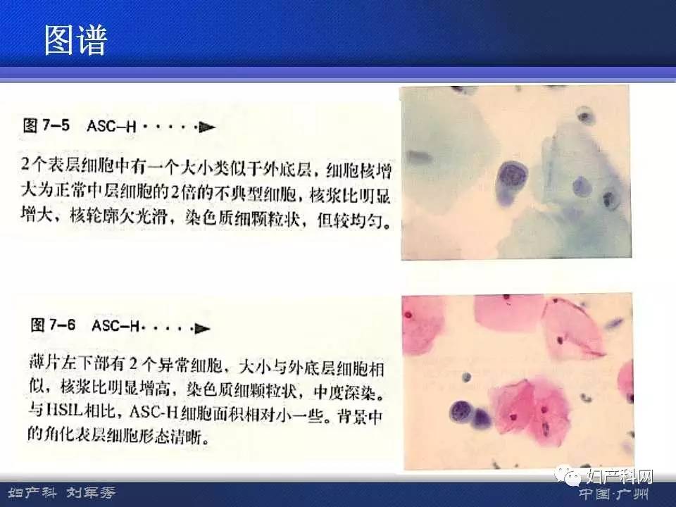 液基细胞学检查是什么(宫颈液基细胞学检查是什么)