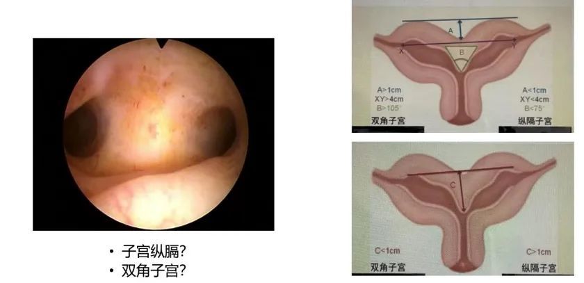 子宫纵隔影响生育吗(纵隔子宫来例假特点)