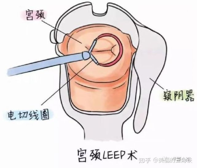 leep刀手术费用多少(leep刀手术要多少钱)