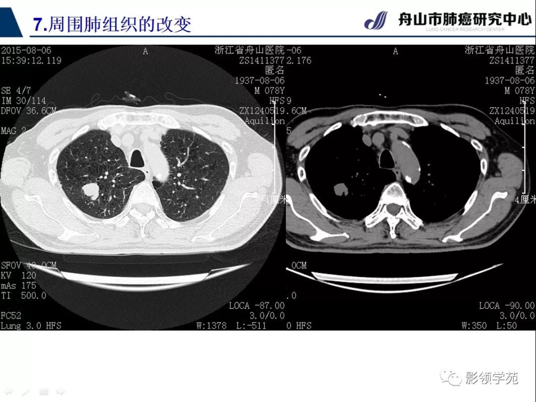 纤维灶(纤维灶是什么意思)