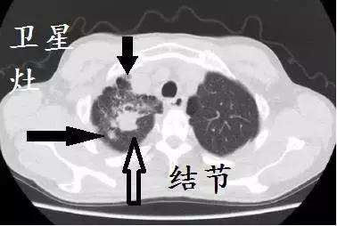 肺部ct怎么看图解(肺部ct怎么看图解 毛玻璃 间质性)