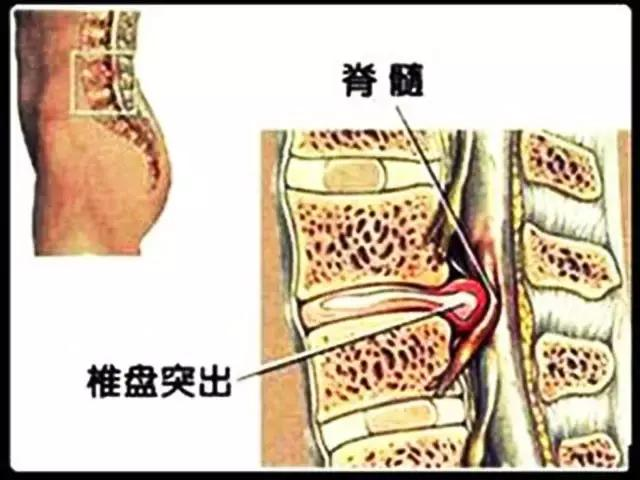 腰椎盘突出疗法(腰椎盘突出疗法有哪几种)