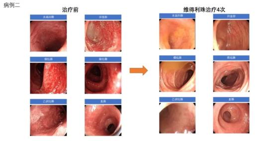 结肠炎的症状(结肠炎的症状有哪些症状吃什么药)