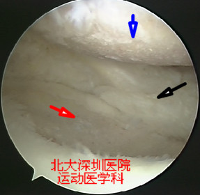 半月板磨损(半月板磨损严重的最好治疗)