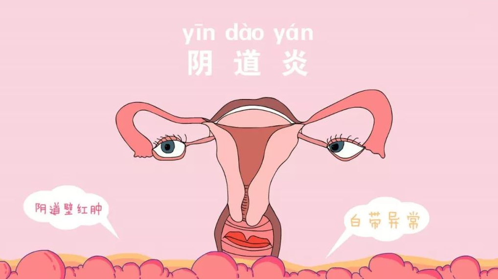 女人的炎症怎么引起的(女生炎症是什么引起的)