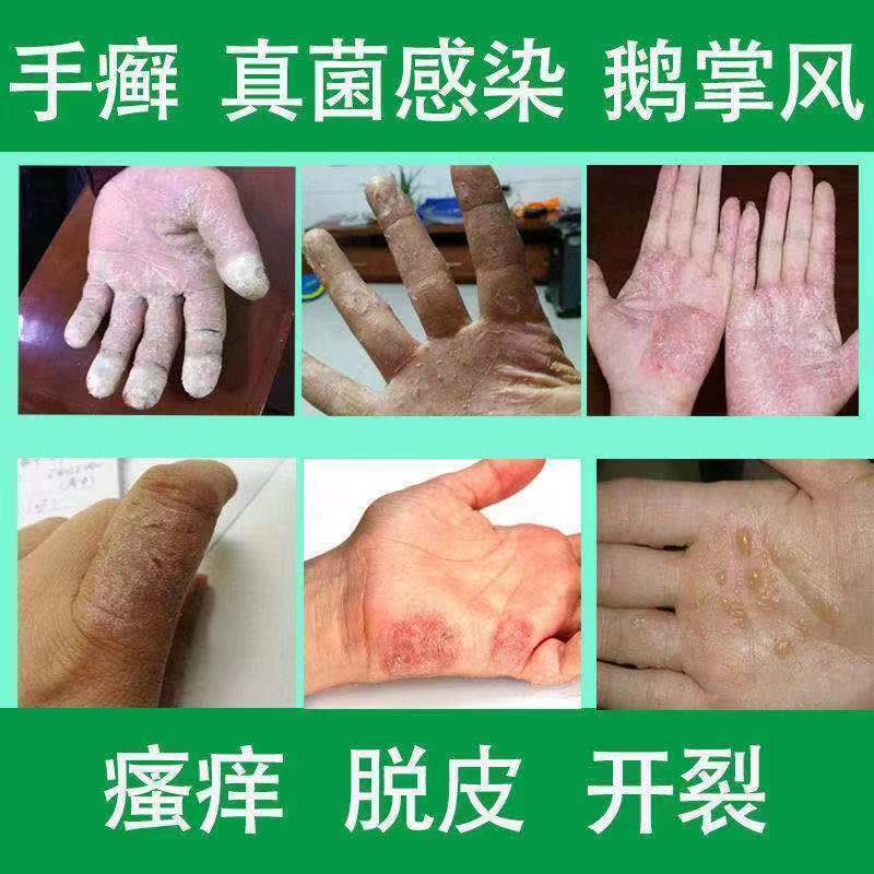 手癣用什么药(手癣用什么药膏效果好)