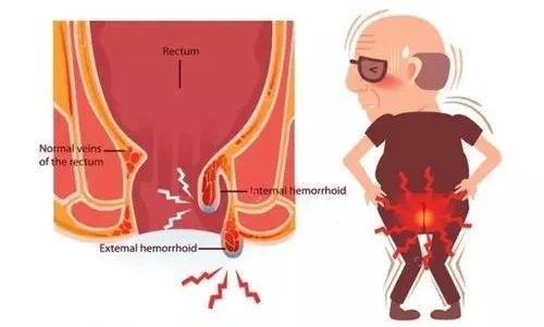 脱肛和痔疮的区别图(一度二度三度脱肛图片)