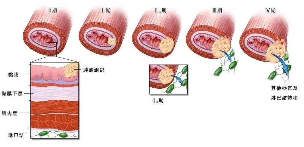 食管癌治疗(食管癌治疗最好的医院是哪些医院)