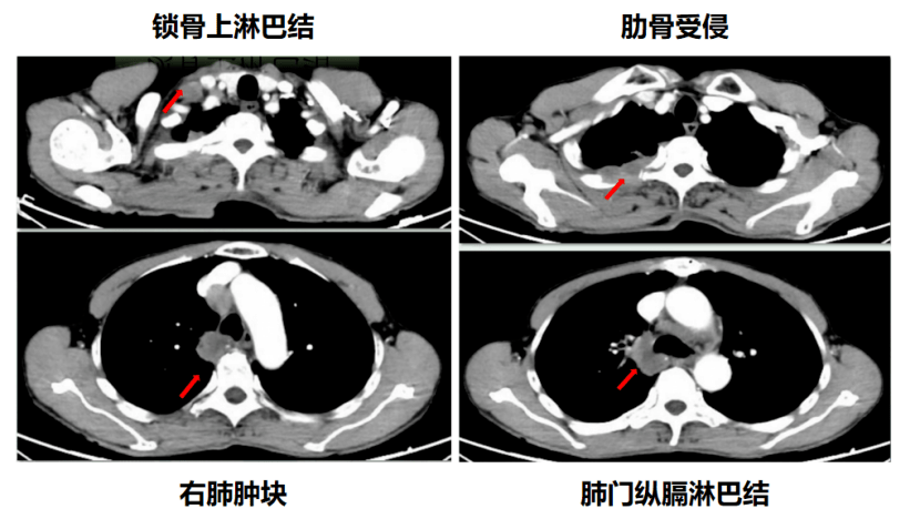 肺部瘤早期能活多久(70岁老人肺部肿瘤能活多久)