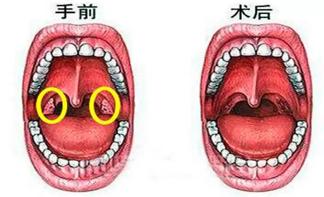 扁桃体炎的治疗(扁桃体炎的治疗原理是什么?)